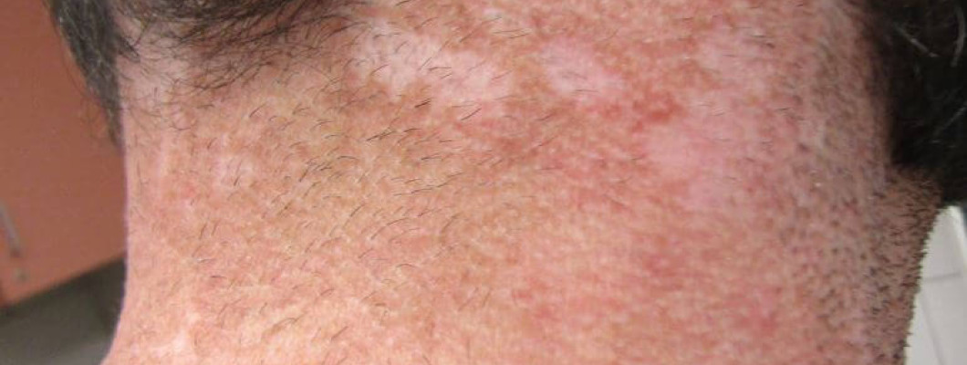 Hypopigmented Rash on Neck