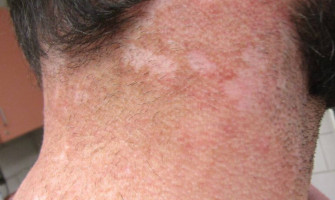 Hypopigmented Rash on Neck Hypopigmented Rash on Neck